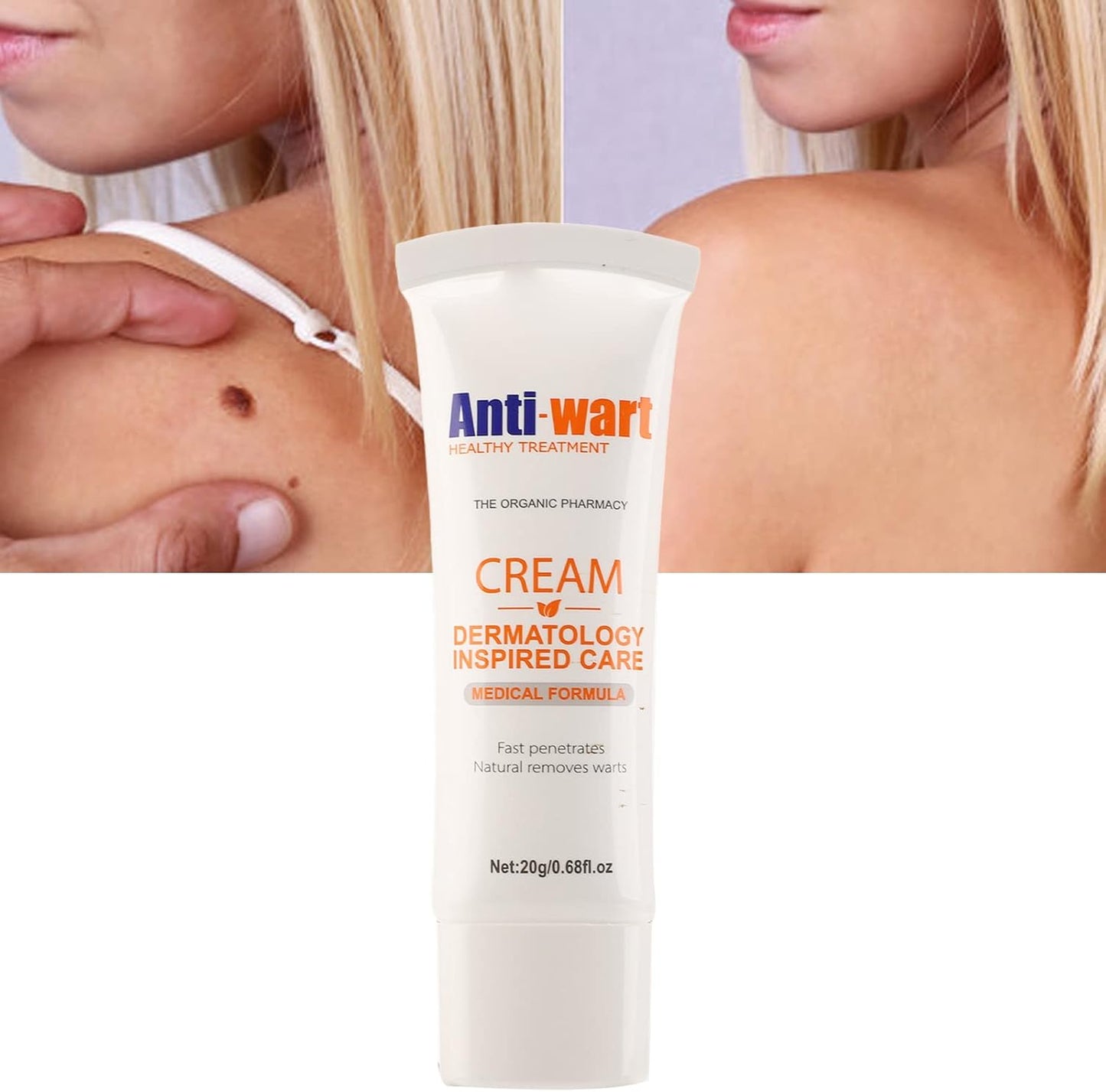 Anti-Wart® Elimina verrugas rápido y sin dolor.